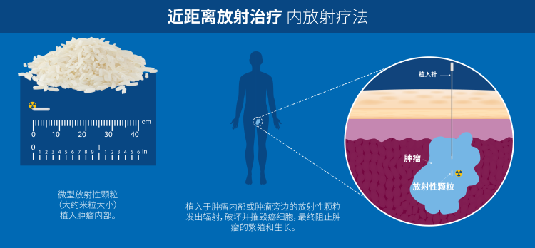 radiotherapy3_v3_ch_brachitherapy.png
